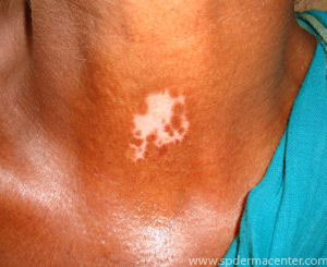 Vitiligo-Before